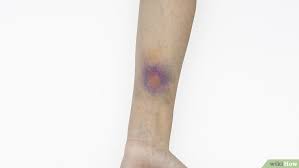 How To Give Yourself A Bruise