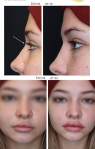 Madelyn Cline Nose Job - Be Strong be Healthy