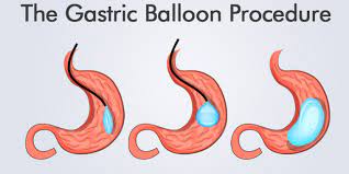 Adjustable Gastric Balloon System Overview