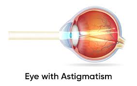 Astigmatism symptoms causes and treatment