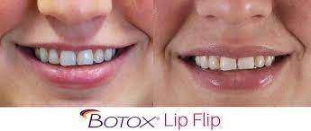 Botox lip flip before and after